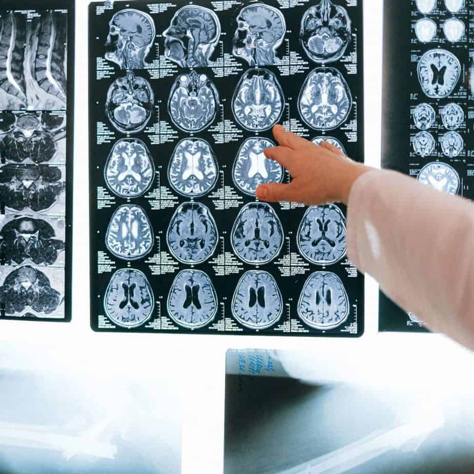 traumatic brain injury expert testimony